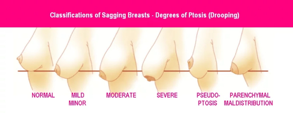 Ptosis - Breast Ptosis degrees of droopiness