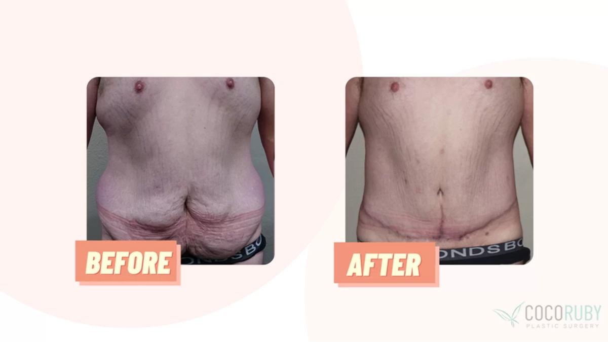 Coco Ruby Blog - Before and After Belt Lipectomy