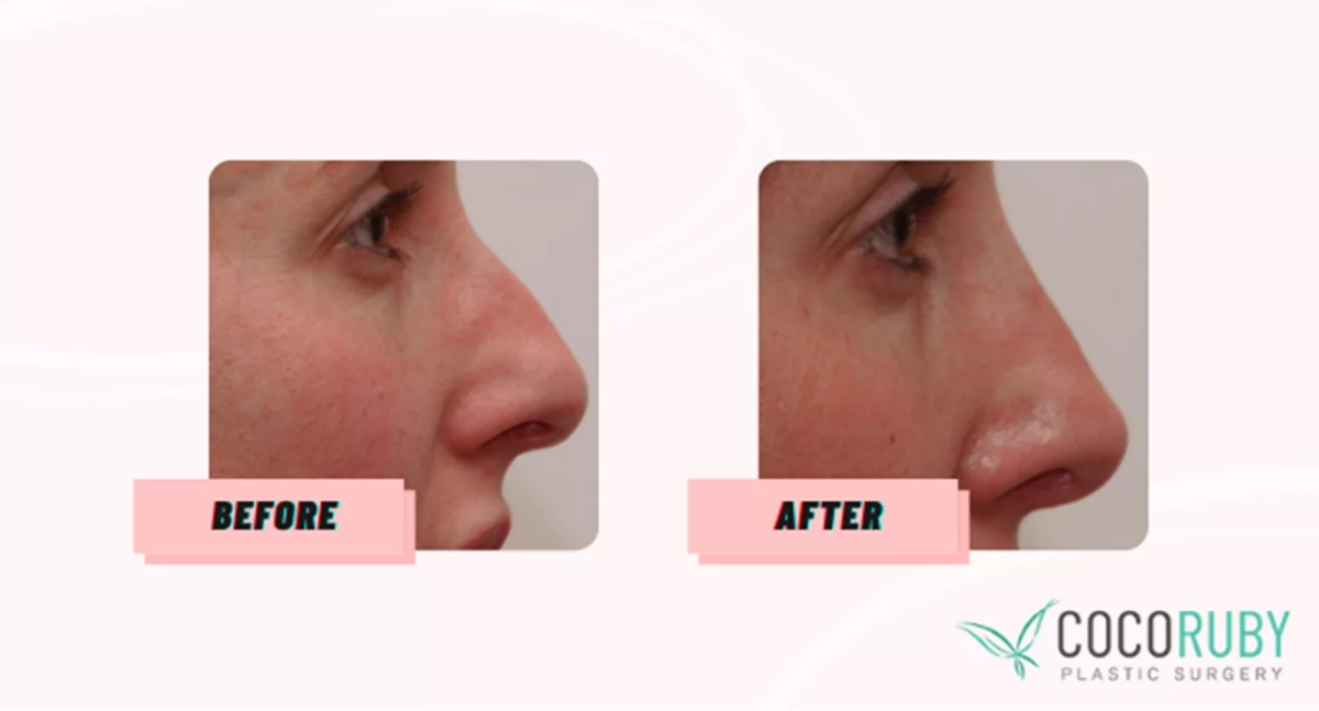 Coco Ruby Blog - Before and After Nose Surgery Sample Gallery Image
