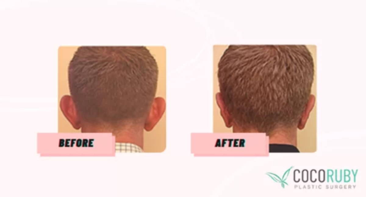 Coco Ruby Plastic Surgery Blog Will Medicare Cover my Ear Surgery Before and After Ear Surgery Image