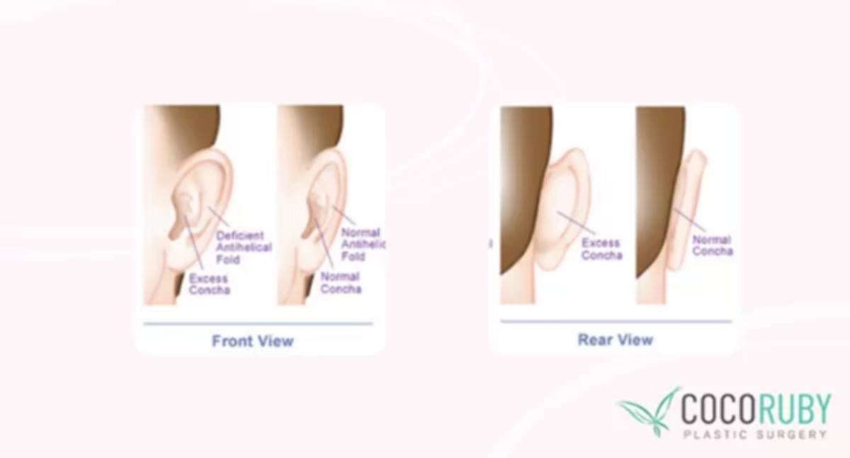 Coco Ruby Plastic Surgery Blog Will Medicare Cover my Ear Surgery Front and Back Ear Illustration