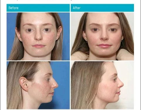 5_26_22_rhinoplasty_dr-stephen-kleid-IDSK11