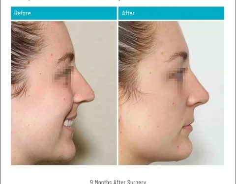 5_26_22_rhinoplasty_dr-stephen-kleid-IDSK21