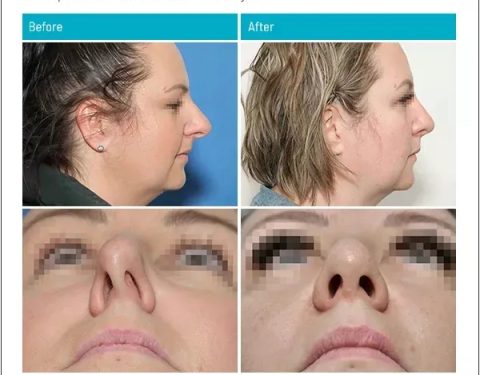 5_26_22_rhinoplasty_dr-stephen-kleid-IDSK31