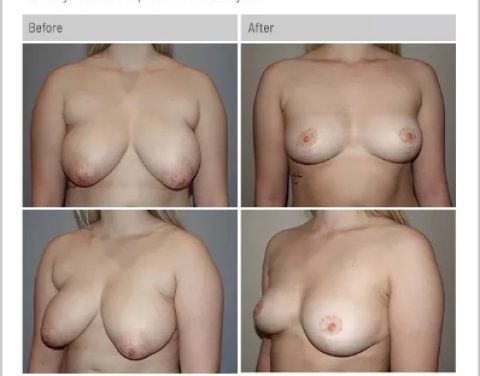 6_14_22_breast-reduction_dr-craig-rubinstein-IDCR1641