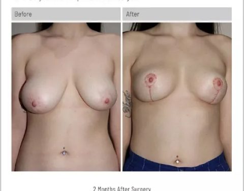 6_14_22_breast-reduction_dr-craig-rubinstein-IDCR1651