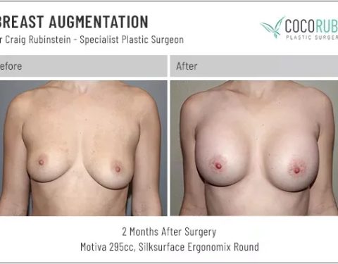 6_15_22_breast-augmentation_dr-craig-rubinstein-IDCR1661