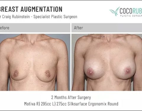 6_15_22_breast-augmentation_dr-craig-rubinstein-IDCR1671