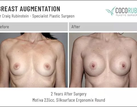 6_15_22_breast-augmentation_dr-craig-rubinstein-IDCR1681