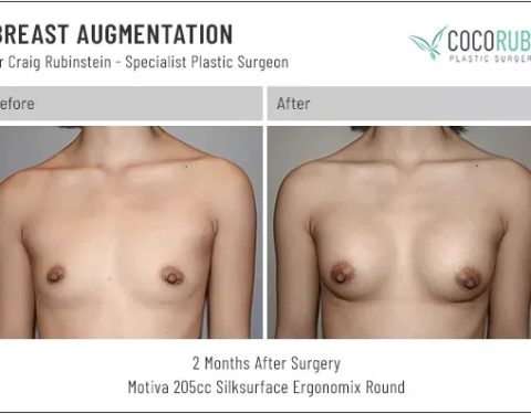 6_15_22_breast-augmentation_dr-craig-rubinstein-IDCR1701