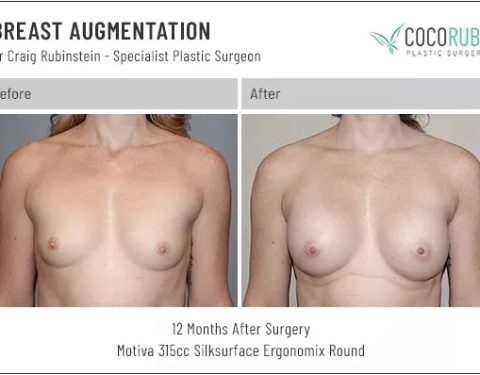 6_15_22_breast-augmentation_dr-craig-rubinstein-IDCR1711