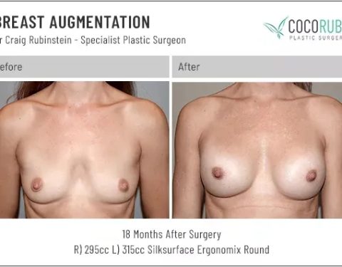 6_15_22_breast-augmentation_dr-craig-rubinstein-IDCR1721