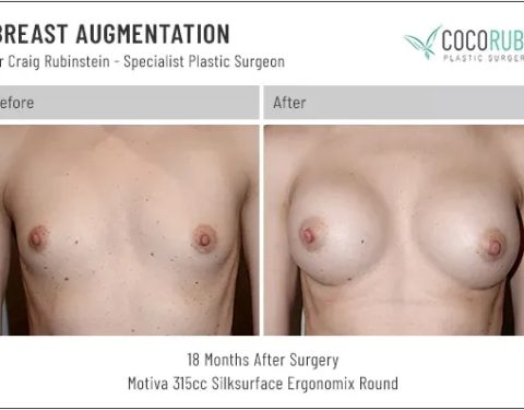 6_15_22_breast-augmentation_dr-craig-rubinstein-IDCR1731