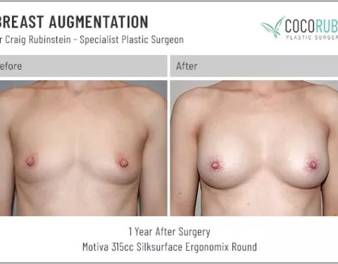 6_15_22_breast-augmentation_dr-craig-rubinstein-IDCR1741