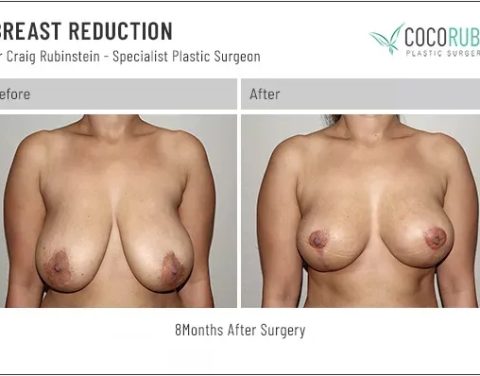 7_11_22_breast-reduction_dr-craig-rubinstein_IDCR1821
