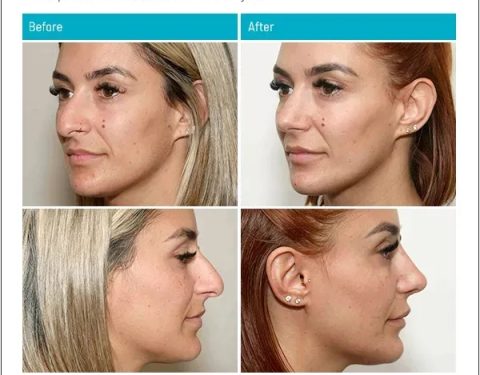 7_11_22_rhinoplasty_dr-stephen-kleid-IDSK51
