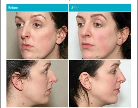 7_11_22_rhinoplasty_dr-stephen-kleid_IDSK61