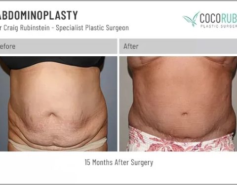 7_27_22_tummy-tuck_dr-craig-rubinstein_CR1841
