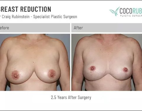 8_22_22_breast-reduction_dr-craig-rubinstein_IDCR2001