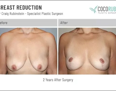 9_7_22_breast-reduction_dr-craig-rubinsteinIDCR2011