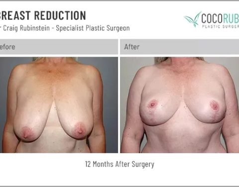 9_8_22_breast-reduction_dr-craig-rubinstein_IDCR1851
