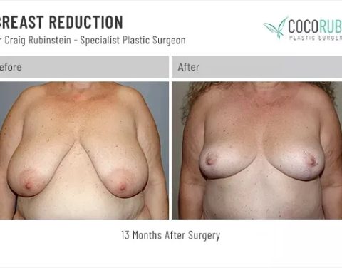 9_8_22_breast-reduction_dr-craig-rubinstein_IDCR1861
