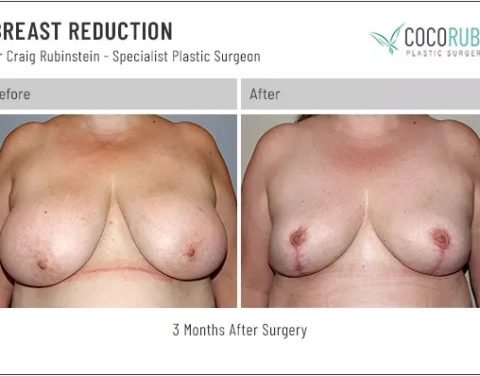 9_8_22_breast-reduction_dr-craig-rubinstein_IDCR1871