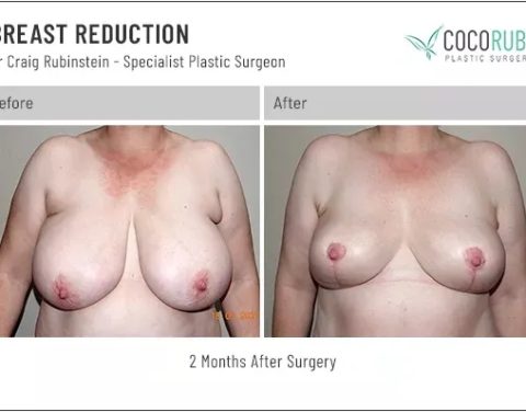 9_8_22_breast-reduction_dr-craig-rubinstein_IDCR1911