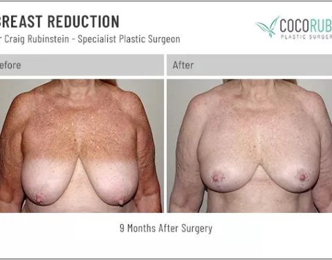 9_8_22_breast-reduction_dr-craig-rubinstein_IDCR1941