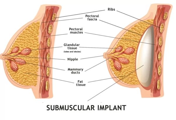 CocoRuby Plastic Surgery Blog Capsular Contracture - Submuscular Implant Image Illustration with Labels
