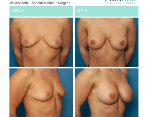 Mr-Gary-Kode-Breast-Augmentation-ID-GK10-v2