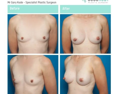 Mr-Gary-Kode-Breast-Augmentation-ID-GK11-v2