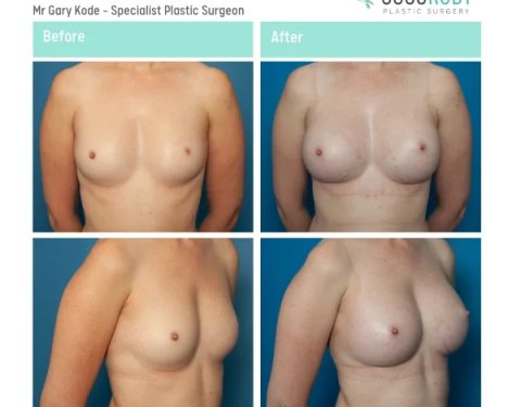 Mr-Gary-Kode-Breast-Augmentation-ID-GK3-v2