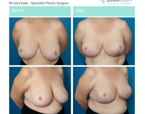 Mr-Gary-Kode-Breast-Reduction-ID-GK4-v2