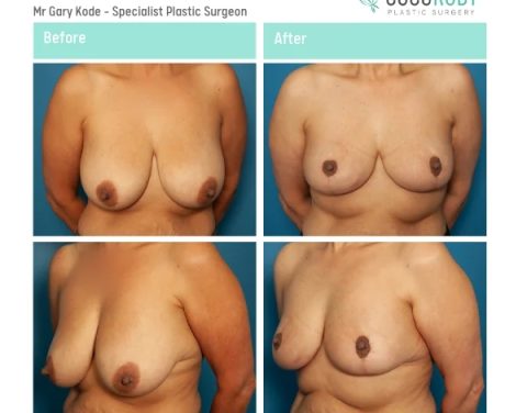 Mr-Gary-Kode-Breast-Reduction-ID-GK5-v2