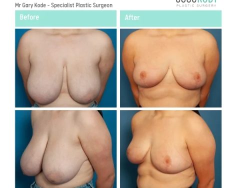 Mr-Gary-Kode-Breast-Reduction-ID-GK6-v2