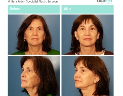 Mr-Gary-Kode-Face-Browlift-Blepha-ID-GK17