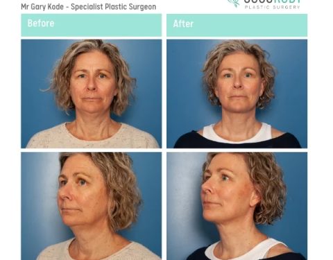 Mr-Gary-Kode-Facelift-ID-GK13-v2