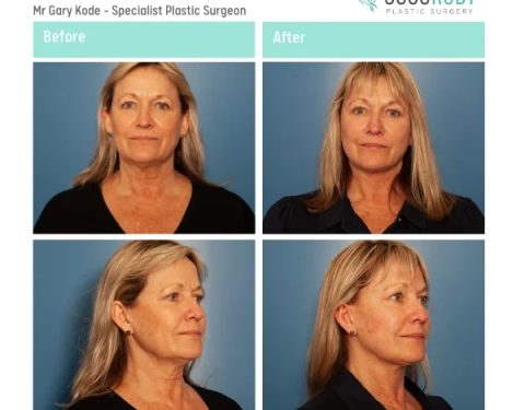 Mr-Gary-Kode-Facelift-ID-GK14-v2