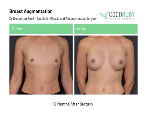 dr-broughton-snell-breast-augmentation-1