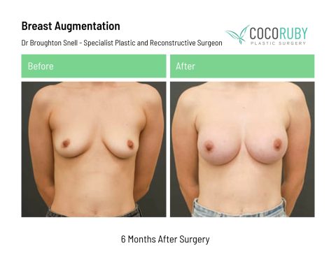 dr-broughton-snell-breast-augmentation-11