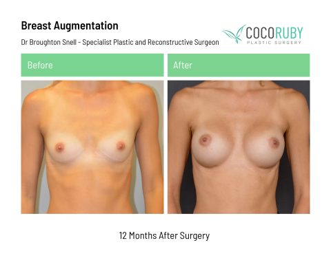 dr-broughton-snell-breast-augmentation-12
