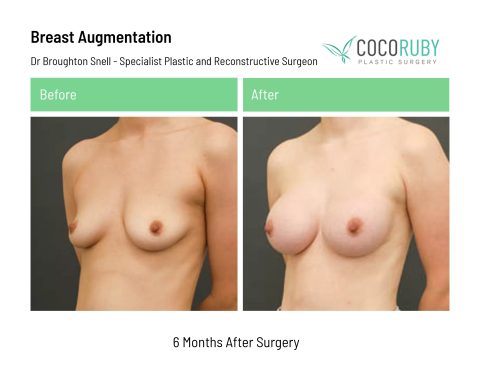 dr-broughton-snell-breast-augmentation-2