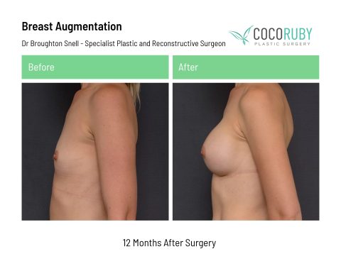 dr-broughton-snell-breast-augmentation-21
