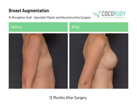 dr-broughton-snell-breast-augmentation-3