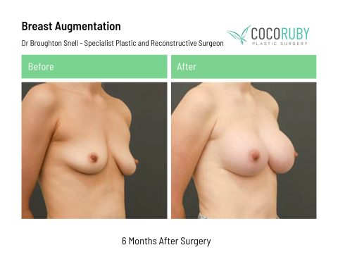 dr-broughton-snell-breast-augmentation-31