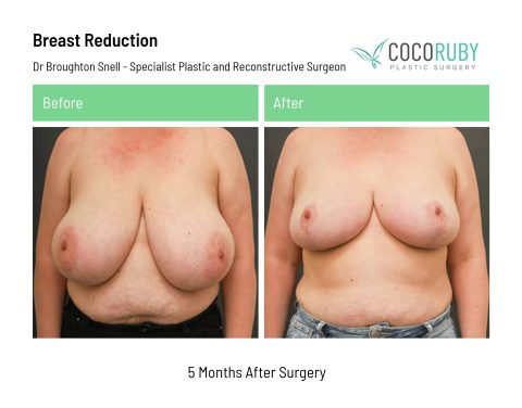 dr-broughton-snell-breast-reduction-1-2