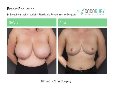 dr-broughton-snell-breast-reduction-11-1