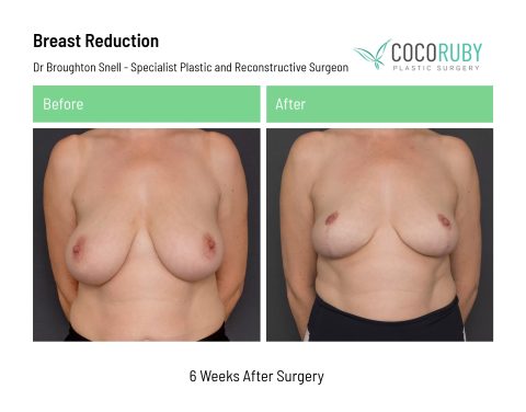 dr-broughton-snell-breast-reduction-12-1
