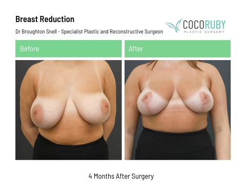 dr-broughton-snell-breast-reduction-13